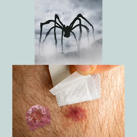 picadura de araña fotos