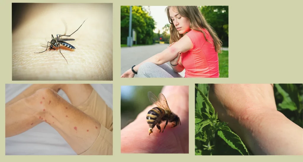 picadura de insectos