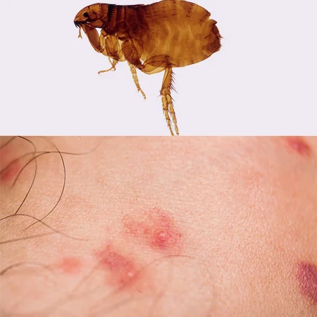 picadura de pulga y pulga